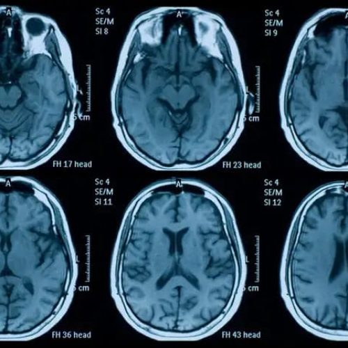 A pandemia pode ter envelhecido o seu cérebro