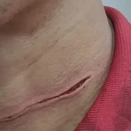 Homem tem pescoço cortado por linha com cerol enquanto andava de bicicleta em Porto Velho